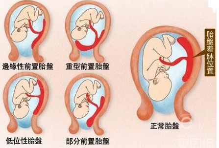  判断胎盘位置的男性和女性可靠吗?