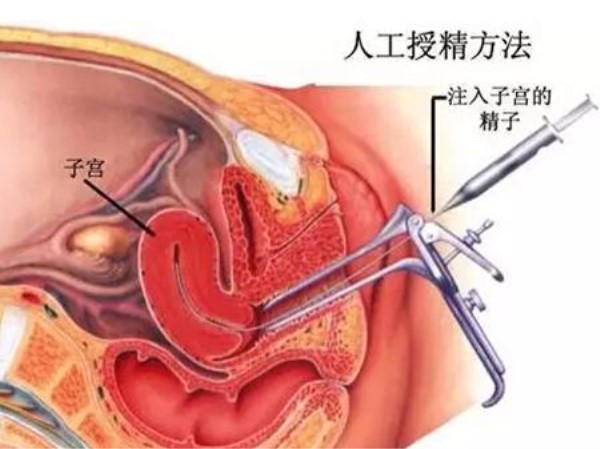  人工授精是如何操作的?